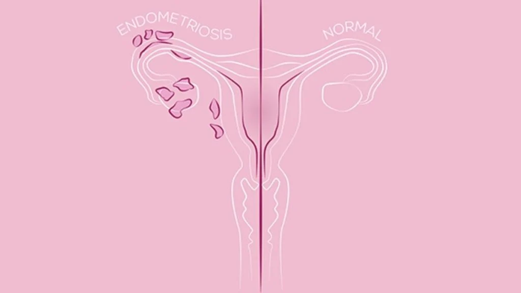 Mjesec osviještenosti o endometriozi: Zašto žene čekaju 8 godina na dijagnozu