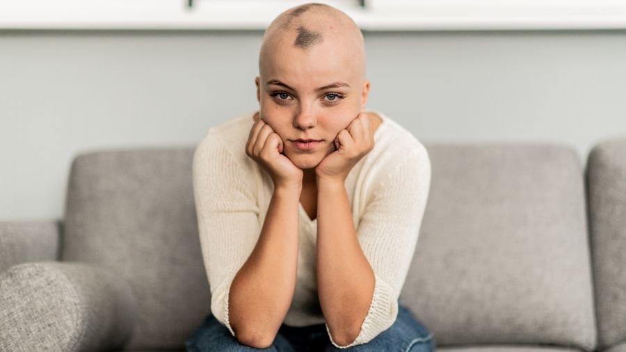 alopecija